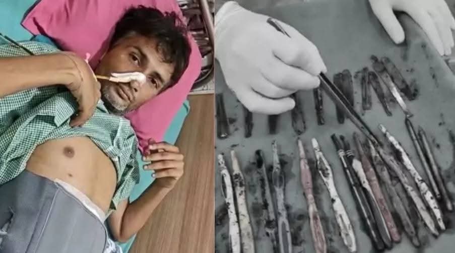 अजब-गजब मामला: मरीज के पेट से निकले 29 चम्मच, 19 टूथब्रश, 2 पेन, डॉक्टर भी हैरान