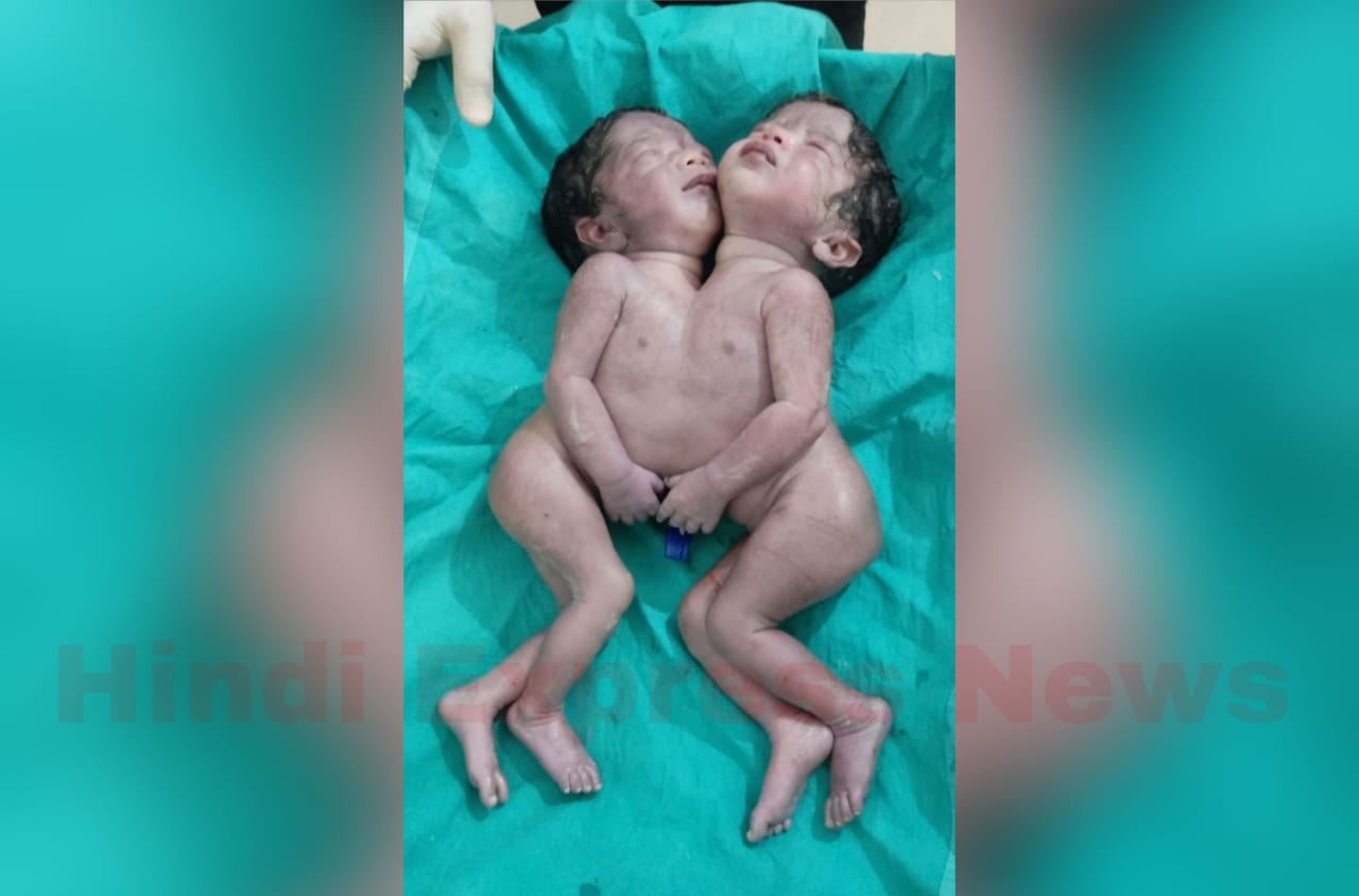 महराजगंज में प्रकृति का दुर्लभ करिश्मा, पेट से जुड़ी जुड़वा बच्चियों का जन्म, डॉक्टर भी रह गए हैरान